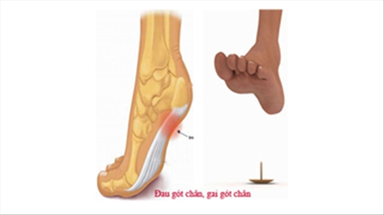 Nhận diện những nguyên nhân mắc bệnh gai xương gót chân