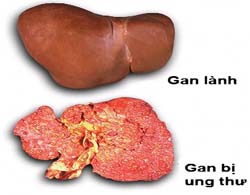 Bạn không nên để chủ quan với những căn bệnh về u gan