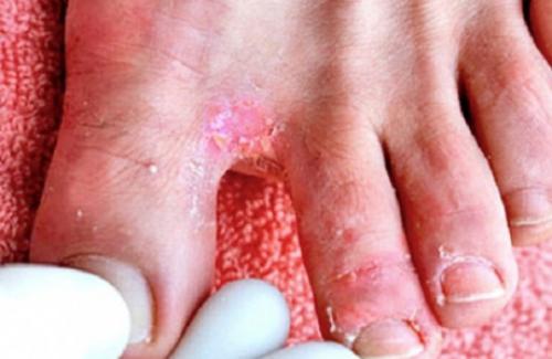 Tiết lộ 4 bài thuốc y học cổ truyền trị nấm kẽ chân tay hiệu quả