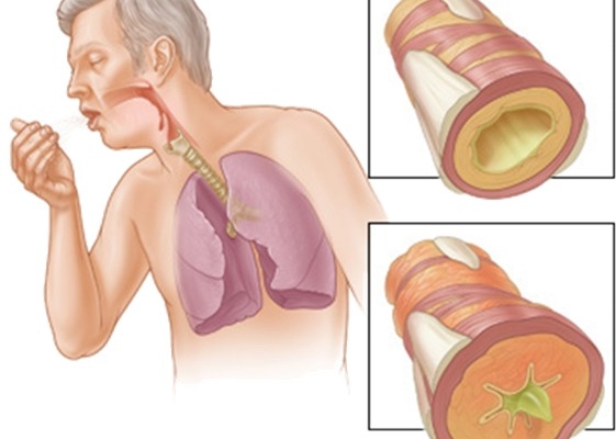 Nguy hiểm do bệnh xơ phổi ảnh hưởng như thế nào đến sức khỏe bạn?