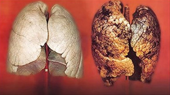 Ung thư biểu mô tuyến phổi - Những điều bạn nên tìm hiểu