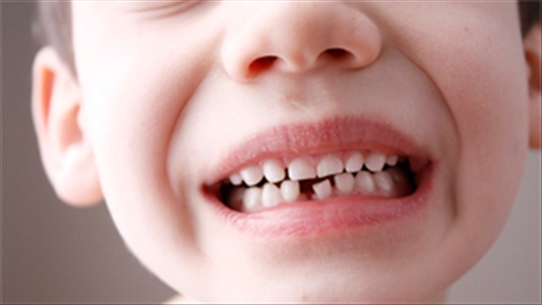Hướng dẫn phụ huynh cách xử trí khi trẻ 'bỗng dưng' gãy răng