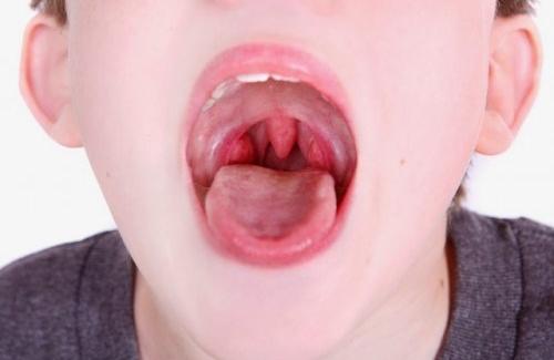 Viêm họng hạt - biểu hiện của bệnh và cách thức điều trị