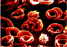 Bệnh máu phần lớn do di truyền, nguy hiểm như thế nào?