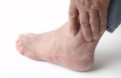 Viêm khớp cổ chân - Phòng bệnh như thế nào cho hiệu quả?