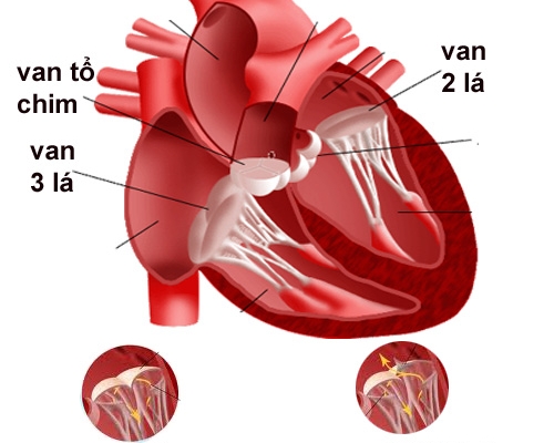 Phương pháp để phòng bệnh van hai lá hiệu quả do thấp tim