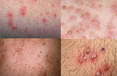 Vi khuẩn là nguyên nhân gây ra hàng loạt các bệnh về da như: Chốc, viêm nang lông..