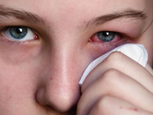 Cách điều trị và tránh viêm mắt, đỏ mắt trong mùa hè