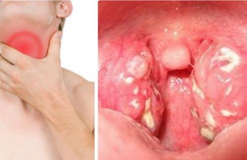 6 dấu hiệu nhận biết ung thư vòm họng giai đoạn đầu
