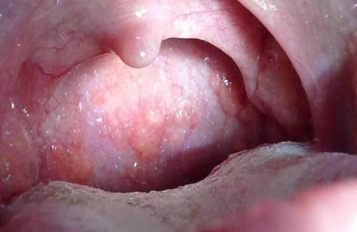 Ung thư vòm họng giai đoạn đầu - Biểu hiện và phương pháp điều trị bệnh