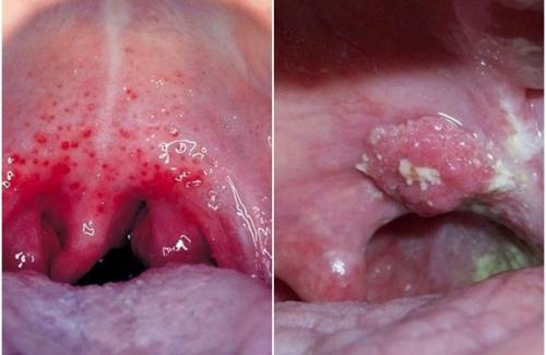Ung thư vòm họng - triệu chứng và cách điều trị bệnh