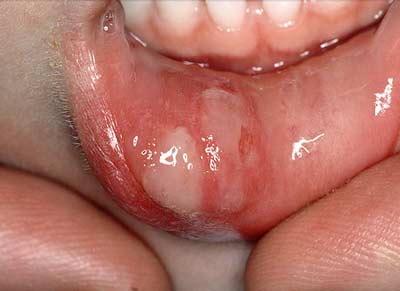Nhận diện viêm loét miệng và một số bệnh thường gặp ở miệng