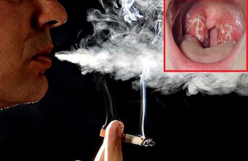 Nguyên nhân bị ung thư vòm họng do thói quen hút thuốc lá