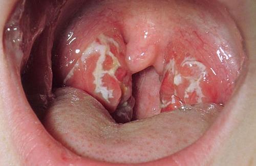 Ung thư vòm họng có chữa được không đang là câu hỏi nhận được nhiều sự quan tâm