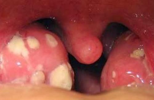 Ung thư vòm họng triệu chứng có dễ nhận biết không?