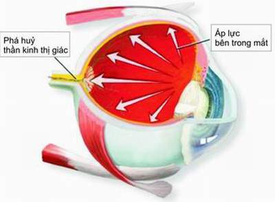 Phòng tránh mù lòa hiệu quả do căn bệnh glôcôm gây ra