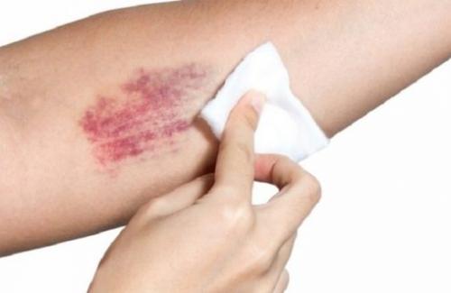 Xuất huyết giảm tiểu cầu - dấu hiệu cảnh báo bệnh qua da