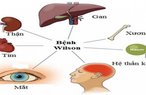 Các thể bệnh thường gặp và cách xử trí khi gặp bệnh Wilson