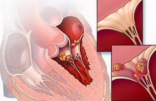 Cách phòng 2 bệnh viêm cơ tim và phình động mạch chủ bóc tách