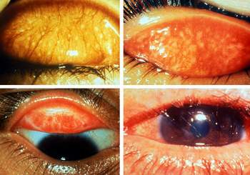Biểu hiện và cách phòng tránh hiệu quả bệnh mắt hột
