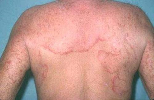 Viêm nang lông, nấm da và một số bệnh da khi nắng nóng vào mùa