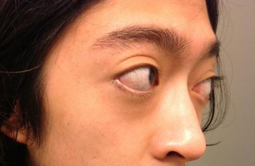 Nguyên nhân và cách khắc phục chứng lồi mắt do bệnh Basedow