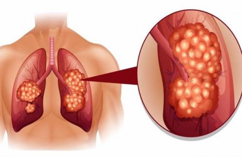 Viêm phổi, ung thư phổi và những triệu chứng nguy hại tới sức khỏe