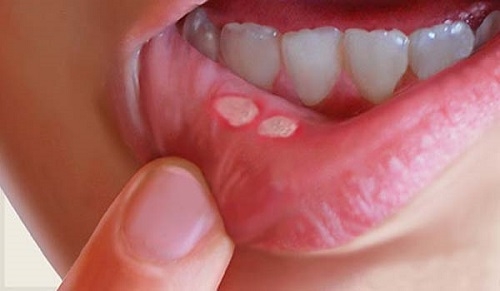 Chữa chứng lở miệng an toàn, hiệu quả với bài thuốc y học cổ truyền