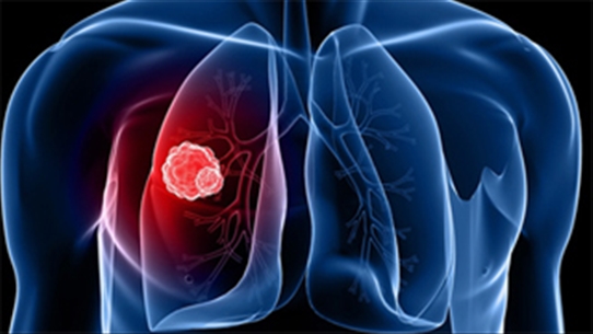 Những triệu chứng của bệnh ung thư biểu mô tế bào vảy của phổi