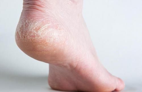 Nguyên nhân và biện pháp phòng tránh của căn bệnh nứt gót chân