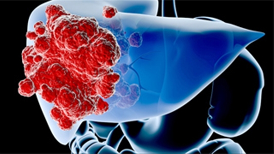 Tìm hiểu về ung thư gan và hướng điều trị của ung thư gan