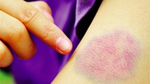 Vết bầm tím trên da - dấu hiệu của căn bệnh nguy hiểm nào?