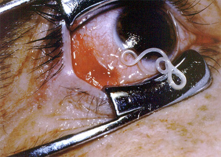 Sán mắt châu Phi, giun Guinea...là những căn bệnh đáng sợ liên quan tới ký sinh trùng