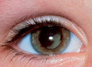 Sùi đỏ, cộm mắt có thể là dấu hiệu của ung thư biểu mô tế bào vảy