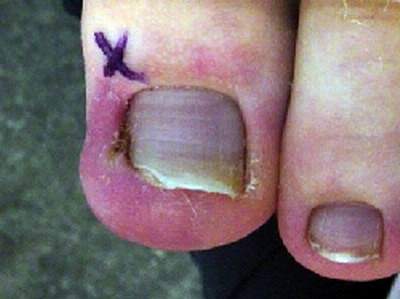 Những căn bệnh phổ biến thường hay gặp ở đôi bàn chân