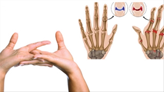 Thói quen bẻ khớp ngón tay gây ra những căn bệnh gì?