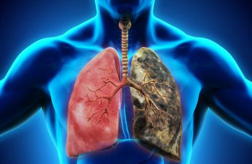 Những dấu hiệu cảnh báo bệnh viêm khớp vảy nến, ung thư phổi bạn nên biết