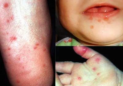 Ðiểm mặt những loại virut gây bệnh nguy hiểm ở trẻ em mùa nắng nóng