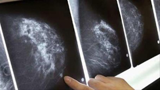 Các phương pháp giúp chẩn đoán chính xác ung thư vú