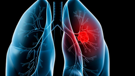 Các dấu hiệu ung thư phổi sớm ở người không hút thuốc