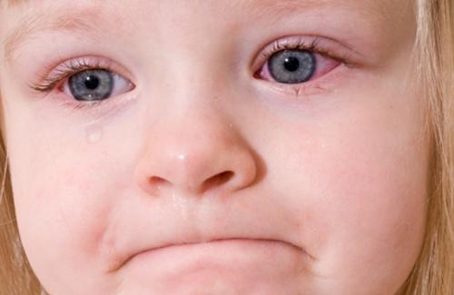 Những triệu chứng đau mắt phổ biến ở trẻ em và cách điều trị