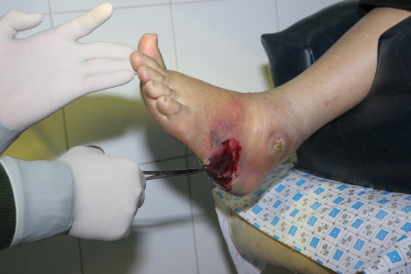 Cách chăm sóc và bảo vệ bàn chân của bệnh nhân đái tháo đường