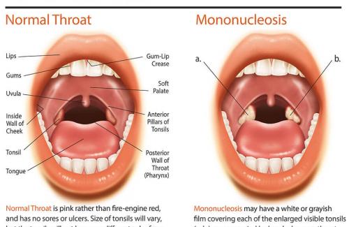 Nụ hôn gây bệnh mononukleoza giống với cảm lạnh, viêm họng