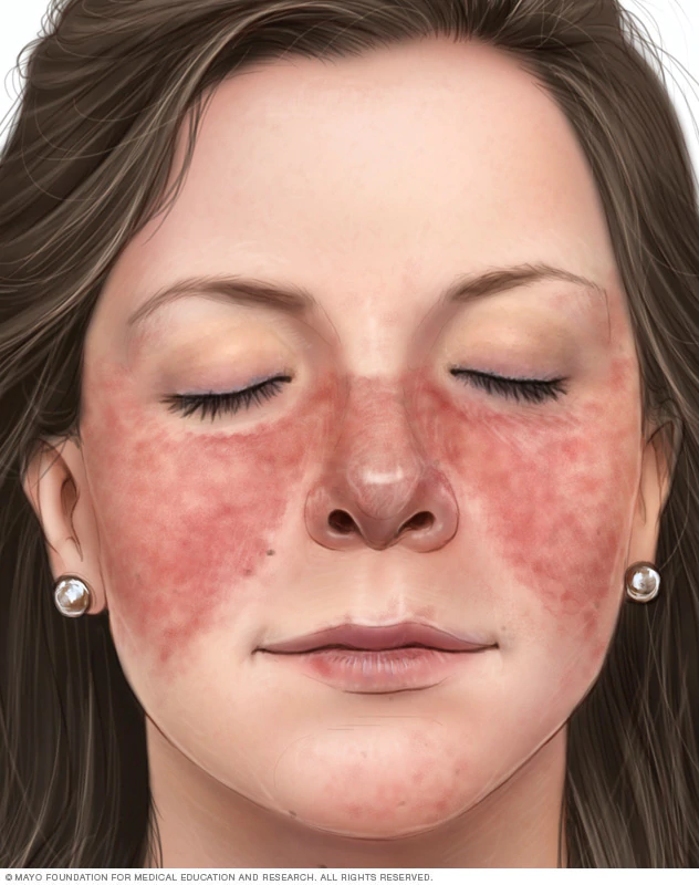 11 triệu chứng giúp bạn có thể tự chẩn đoán bệnh lupus