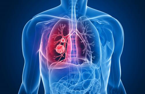 Chẩn đoán và điều trị khối u Pancoast - Nguyên nhân của ung thư phổi