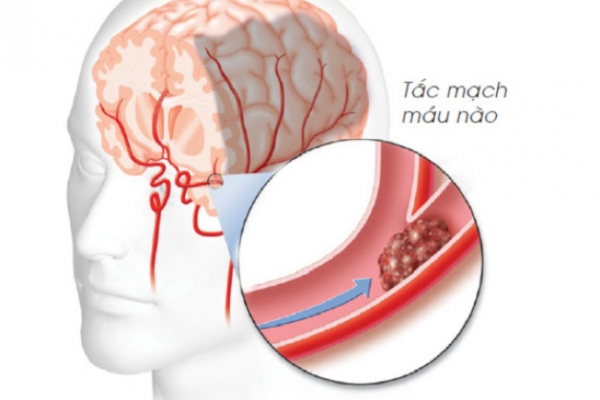 SRối loạn tuần hoàn não dễ dẫn đến căn bệnh tắc mạch máu não