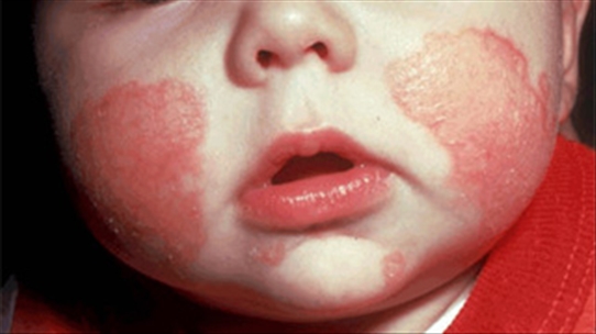 Thuốc bôi da cho trẻ: Những dấu hiệu nhận biết bệnh chàm
