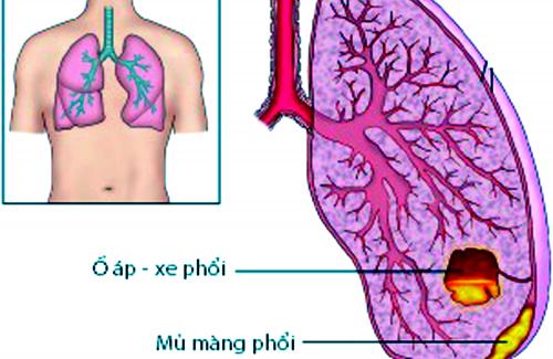 Các triệu chứng và nguyên nhân của bệnh viêm mủ màng phổi