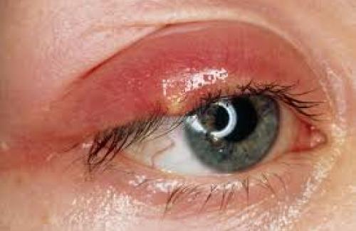 Bệnh đau mắt hột - biến chứng nguy hiểm và cách điều trị hiệu quả