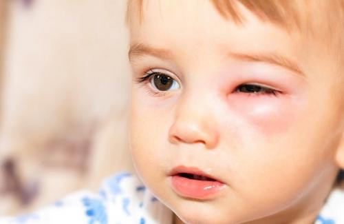 Một số cách sơ cứu khi trẻ nhỏ bị chấn thương ở mắt